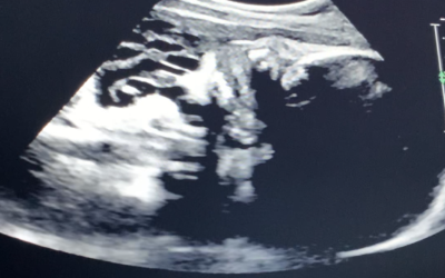 Fulton Smiles – ultrasound at 37 weeks